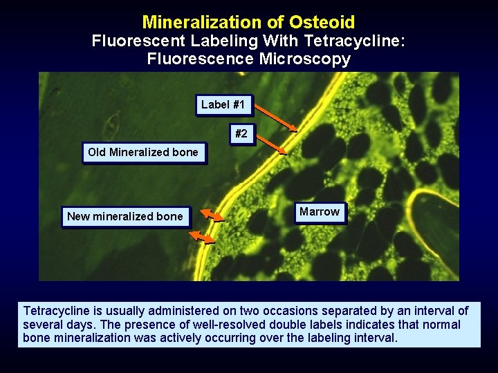 Mineralization of Osteoid Fluorescent Labeling With Tetracycline: Fluorescence Microscopy Label #1 #2 Old Mineralized