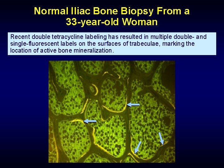 Normal Iliac Bone Biopsy From a 33 -year-old Woman Recent double tetracycline labeling has