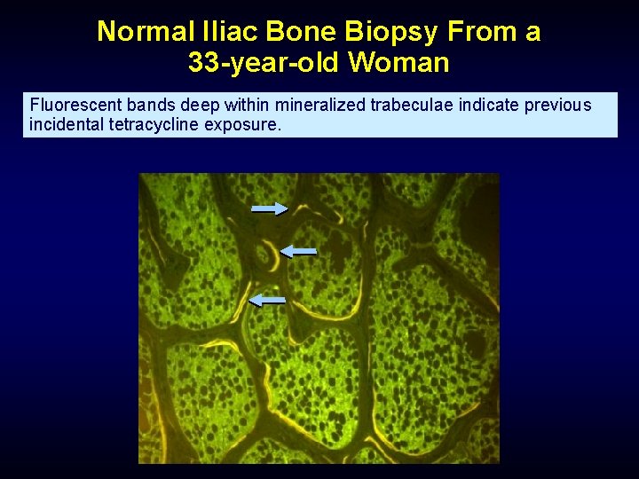 Normal Iliac Bone Biopsy From a 33 -year-old Woman Fluorescent bands deep within mineralized