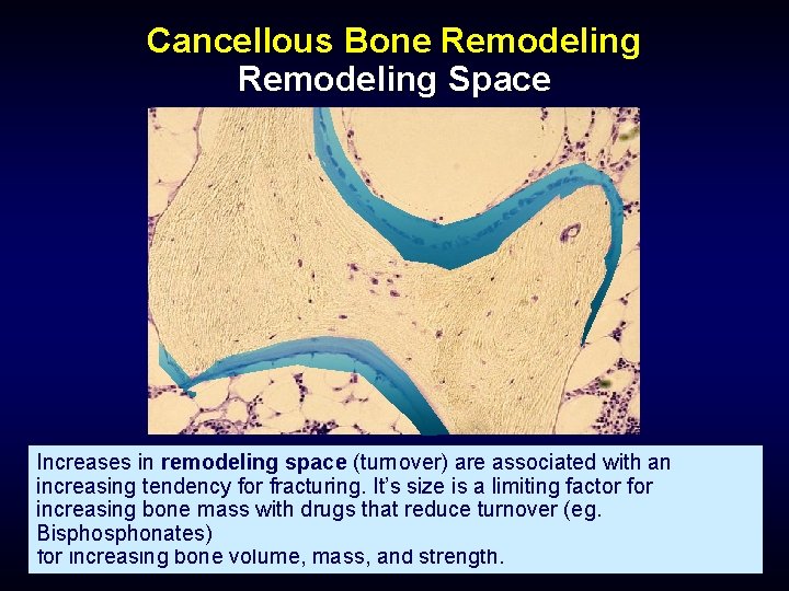 Cancellous Bone Remodeling Space Increases The remodeling in remodeling space (RS)refers space (turnover) to
