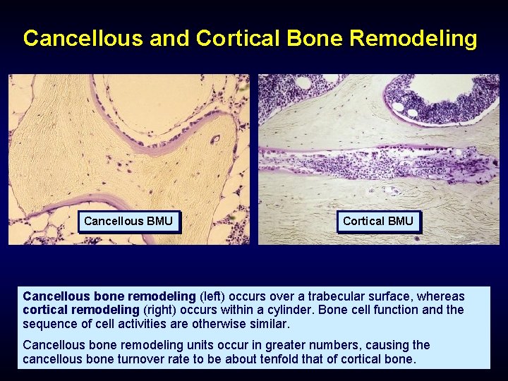 Cancellous and Cortical Bone Remodeling Cancellous BMU Cortical BMU Cancellous bone remodeling (left) occurs