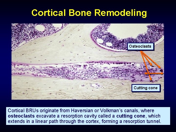 Cortical Bone Remodeling Osteoclasts Cutting cone Cortical BRUs originate from Haversian or Volkman’s canals,