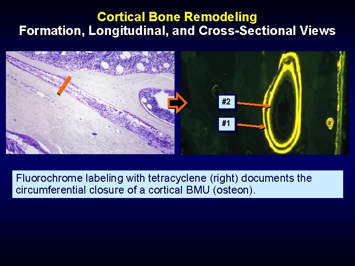 Cortical Bone Remodeling Formation, Longitudinal, and Cross-Sectional Views #2 #1 Fluorochrome labeling with tetracyclene