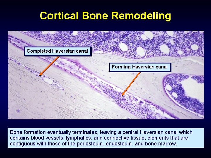 Cortical Bone Remodeling Completed Haversian canal Forming Haversian canal Bone formation eventually terminates, leaving