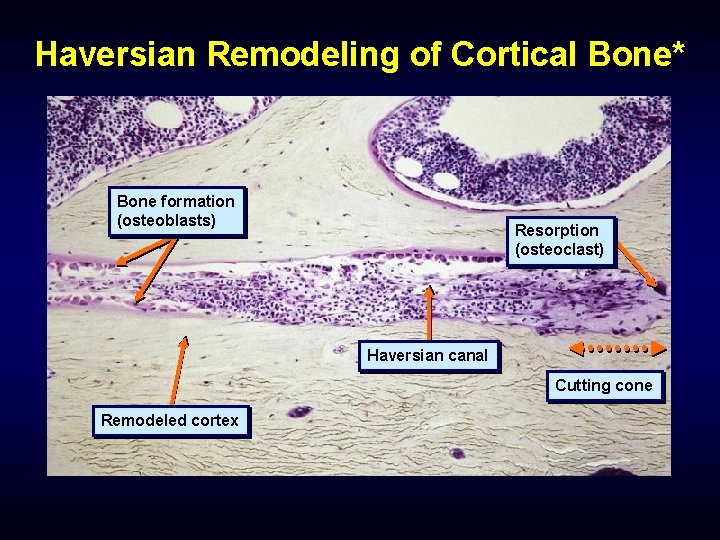 Haversian Remodeling of Cortical Bone* Bone formation (osteoblasts) Resorption (osteoclast) Haversian canal Cutting cone