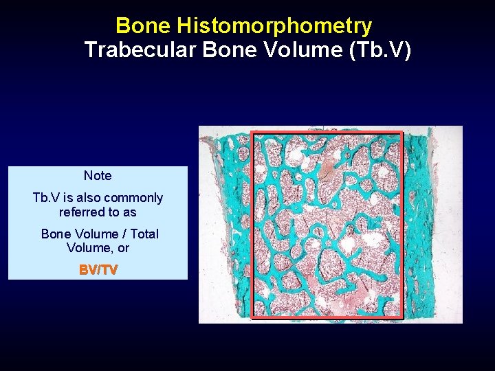 Bone Histomorphometry Trabecular Bone Volume (Tb. V) Note Tb. V is also commonly referred