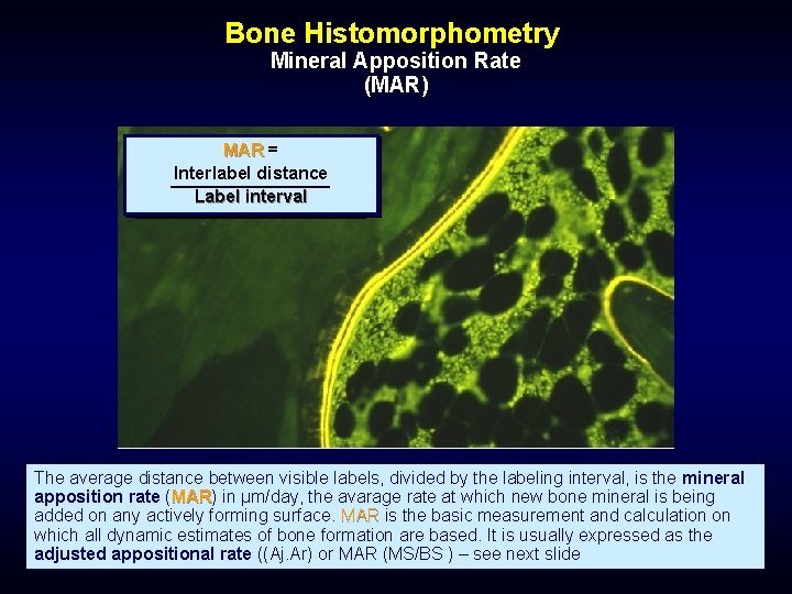 Bone Histomorphometry Mineral Apposition Rate (MAR) MAR = Interlabel distance Label interval The average
