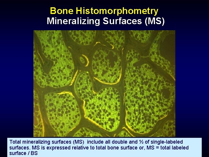 Bone Histomorphometry Mineralizing Surfaces (MS) Total mineralizing surfaces (MS) include all double and ½