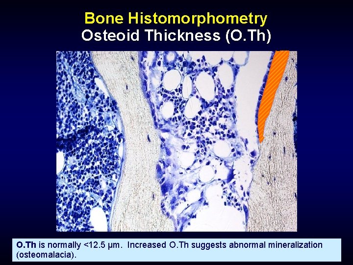 Bone Histomorphometry Osteoid Thickness (O. Th) O. Th is normally <12. 5 µm. Increased