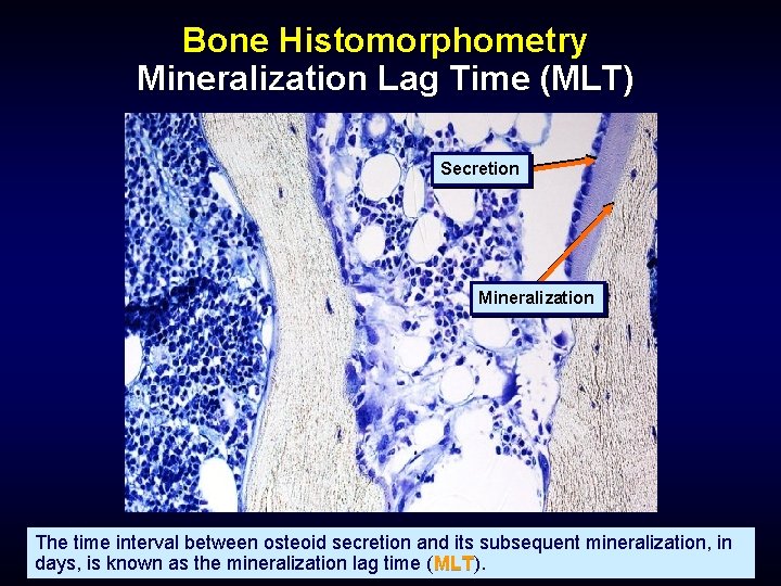 Bone Histomorphometry Mineralization Lag Time (MLT) Secretion Mineralization The time interval between osteoid secretion