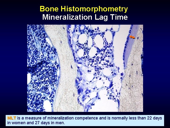 Bone Histomorphometry Mineralization Lag Time MLT is a measure of mineralization competence and is