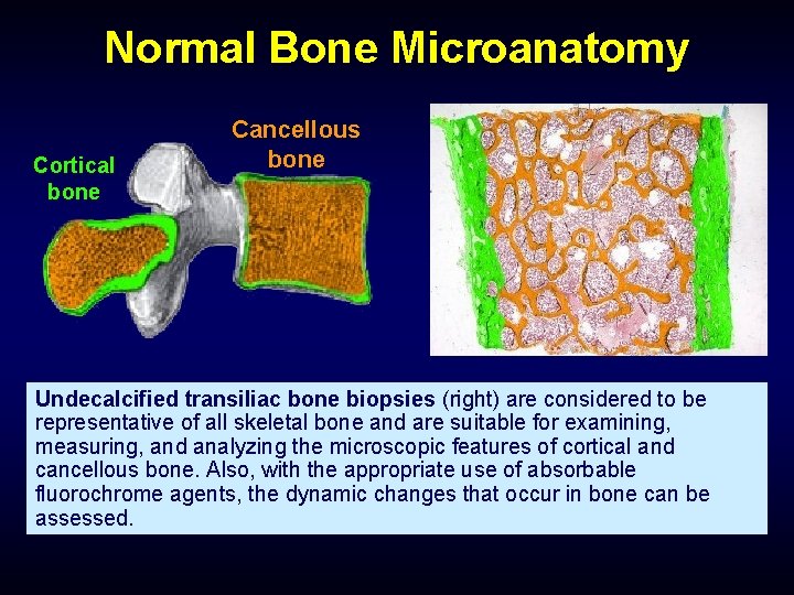 Normal Bone Microanatomy Cortical bone Cancellous bone Undecalcified transiliac bone biopsies (right) are considered