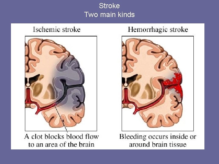 Stroke Two main kinds 