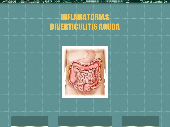 INFLAMATORIAS DIVERTICULITIS AGUDA 