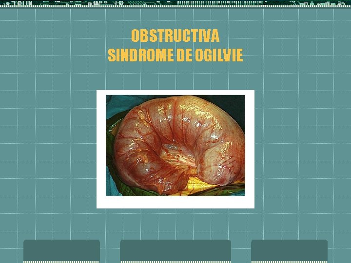 OBSTRUCTIVA SINDROME DE OGILVIE 