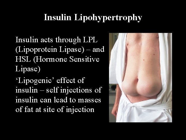 Insulin Lipohypertrophy Insulin acts through LPL (Lipoprotein Lipase) – and HSL (Hormone Sensitive Lipase)