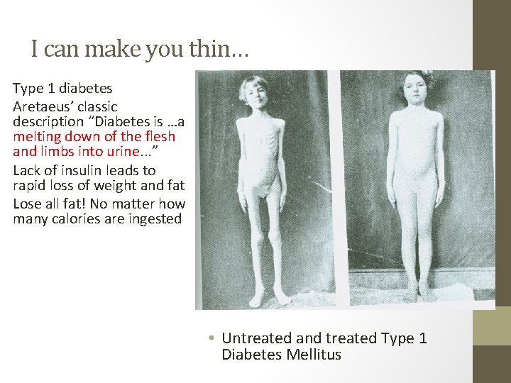 I can make you thin… Type 1 diabetes Aretaeus’ classic description “Diabetes is …a