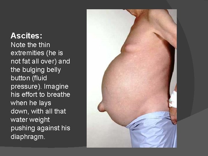 Ascites: Note thin extremities (he is not fat all over) and the bulging belly