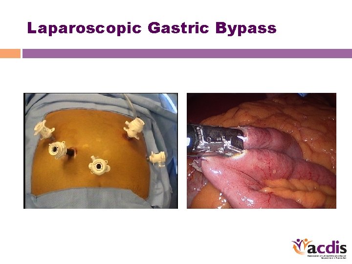 Laparoscopic Gastric Bypass 