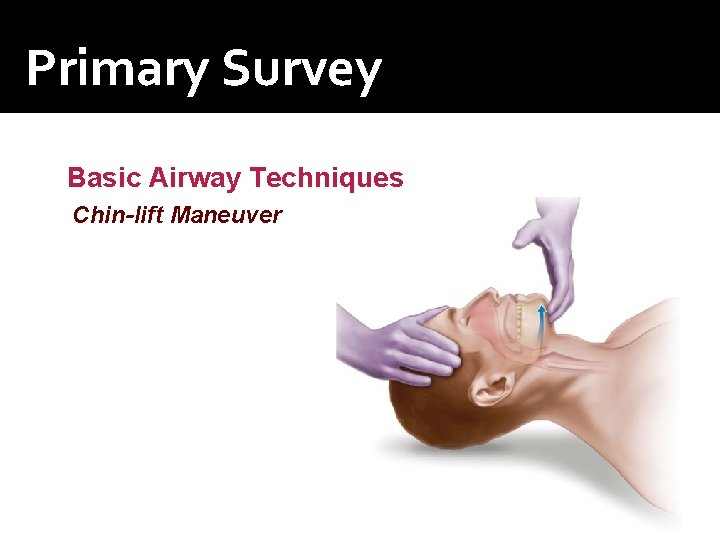 Primary Survey Basic Airway Techniques Chin-lift Maneuver 