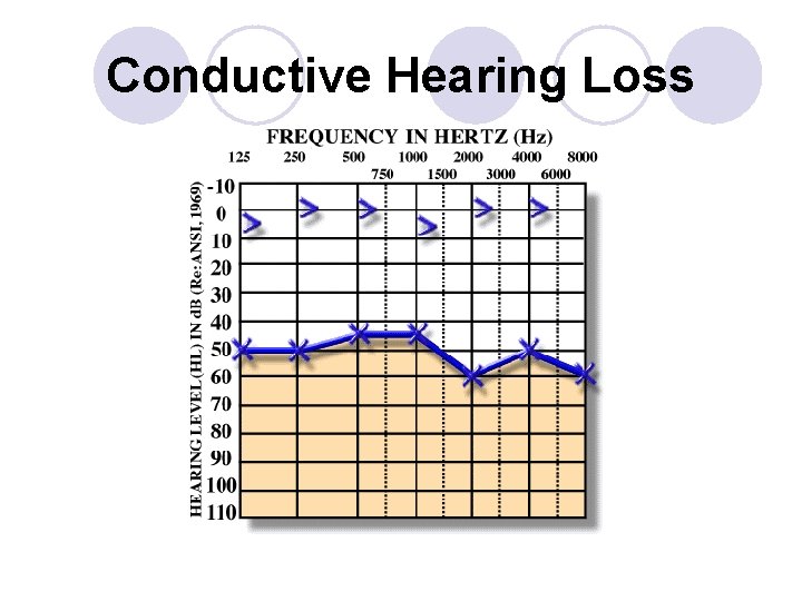 Conductive Hearing Loss 