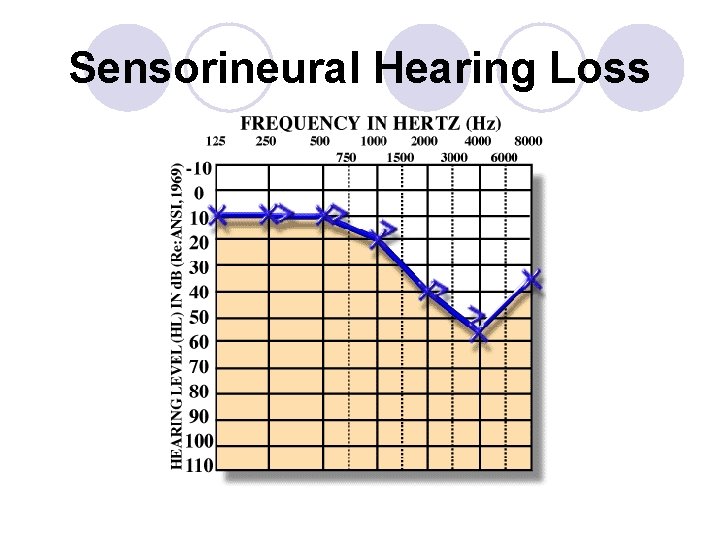 Sensorineural Hearing Loss 