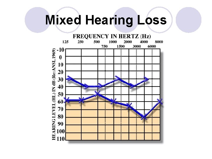 Mixed Hearing Loss 