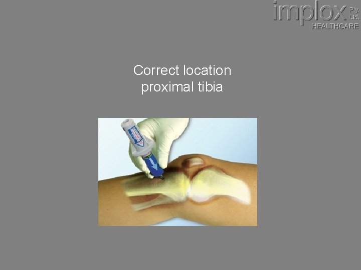Correct location proximal tibia 