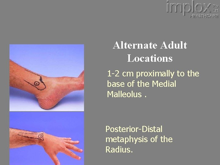 Alternate Adult Locations 1 -2 cm proximally to the base of the Medial Malleolus.