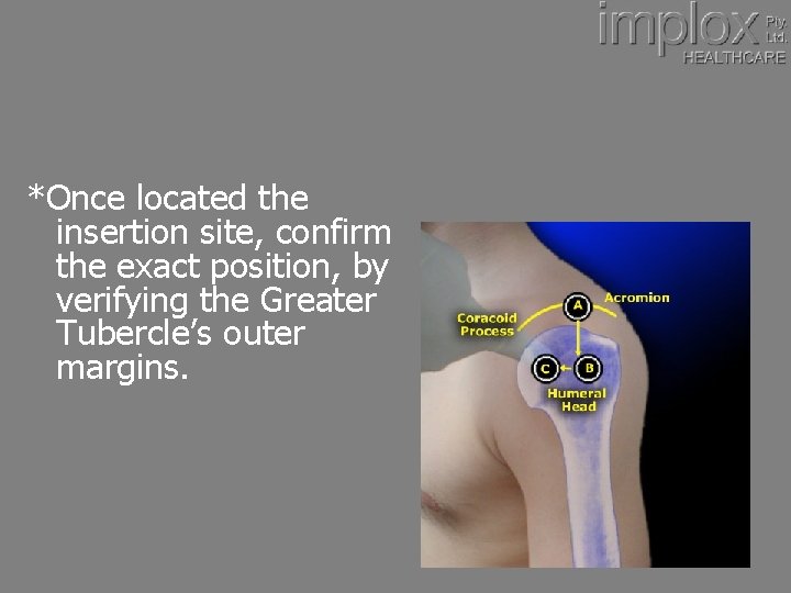 *Once located the insertion site, confirm the exact position, by verifying the Greater Tubercle’s