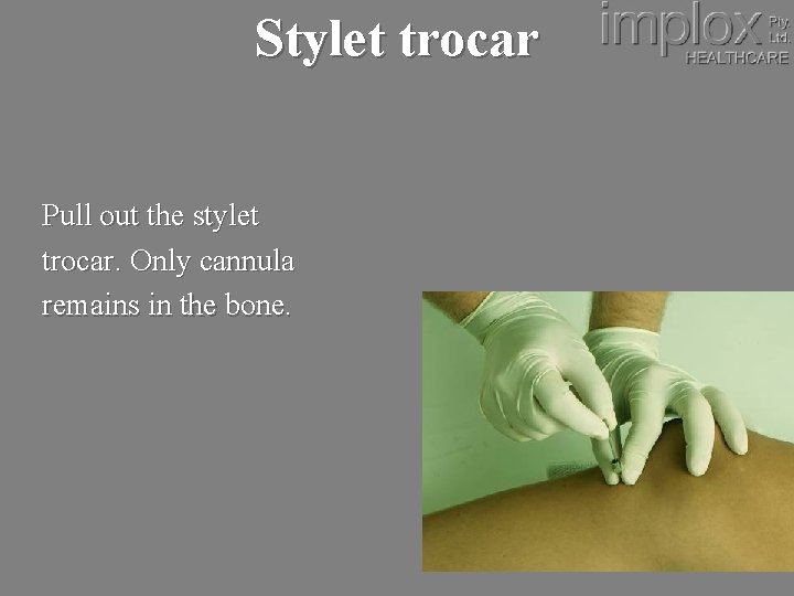 Stylet trocar Pull out the stylet trocar. Only cannula remains in the bone. 