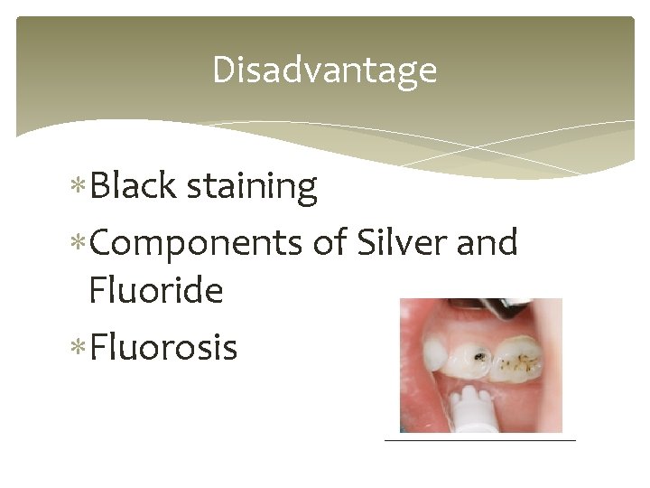 Disadvantage Black staining Components of Silver and Fluoride Fluorosis 