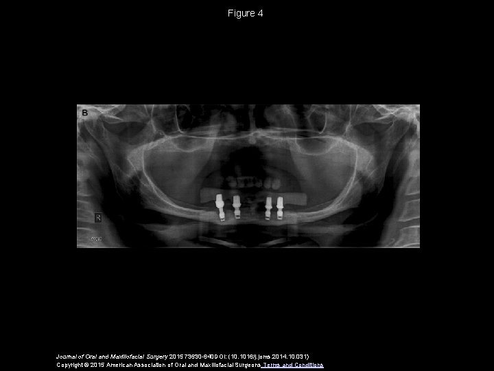 Figure 4 Journal of Oral and Maxillofacial Surgery 2015 73630 -640 DOI: (10. 1016/j.