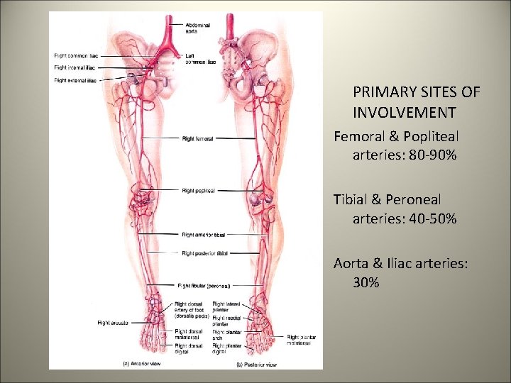 PRIMARY SITES OF INVOLVEMENT Femoral & Popliteal arteries: 80 -90% Tibial & Peroneal arteries: