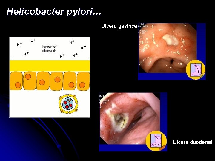 Helicobacter pylori… Úlcera gástrica Úlcera duodenal 