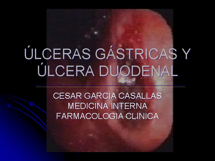 ÚLCERAS GÁSTRICAS Y ÚLCERA DUODENAL CESAR GARCIA CASALLAS MEDICINA INTERNA FARMACOLOGIA CLINICA 