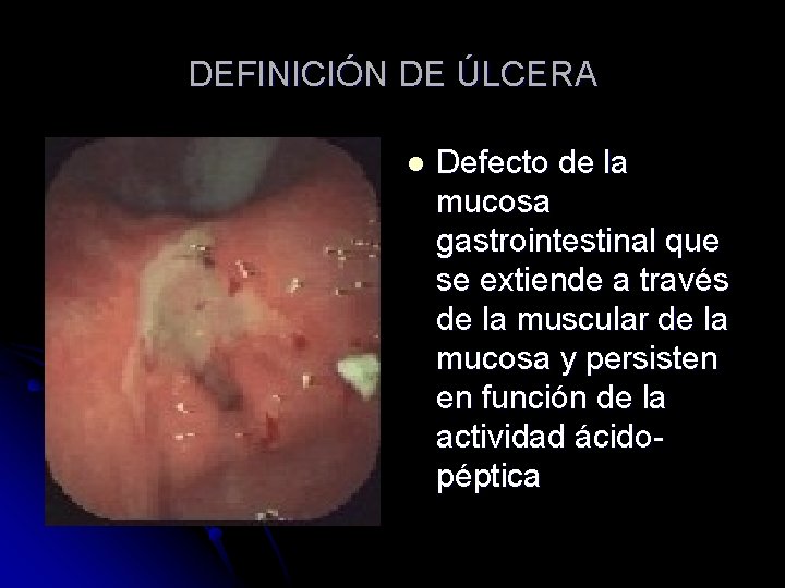 DEFINICIÓN DE ÚLCERA l Defecto de la mucosa gastrointestinal que se extiende a través