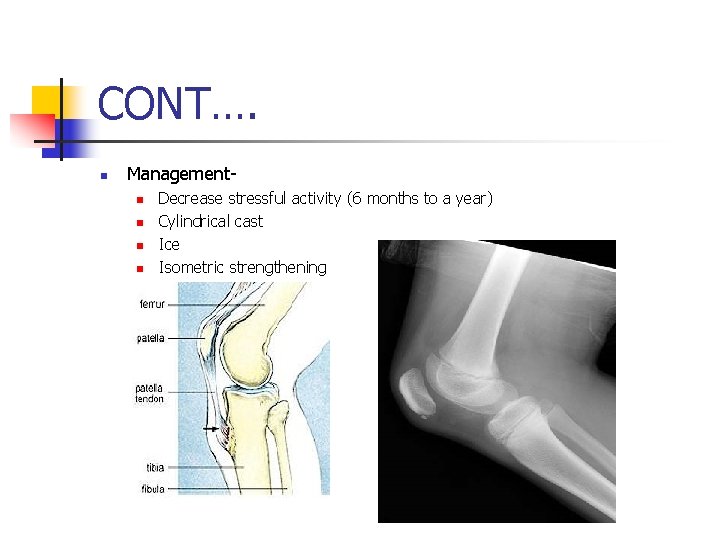 CONT…. n Managementn n Decrease stressful activity (6 months to a year) Cylindrical cast