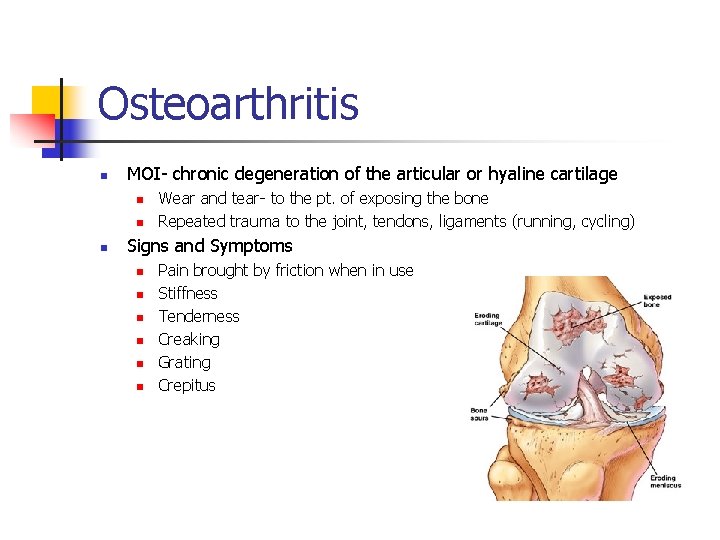 Osteoarthritis n MOI- chronic degeneration of the articular or hyaline cartilage n n n