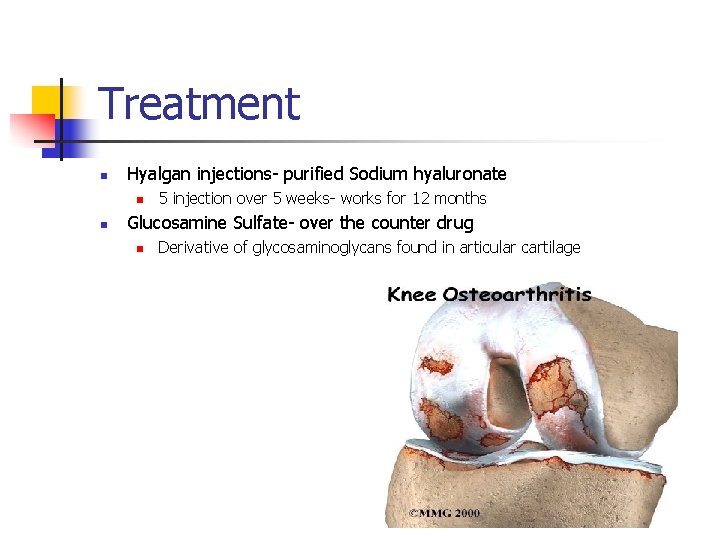 Treatment n Hyalgan injections- purified Sodium hyaluronate n n 5 injection over 5 weeks-