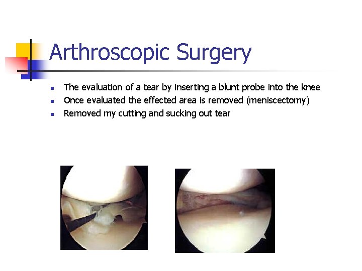 Arthroscopic Surgery n n n The evaluation of a tear by inserting a blunt