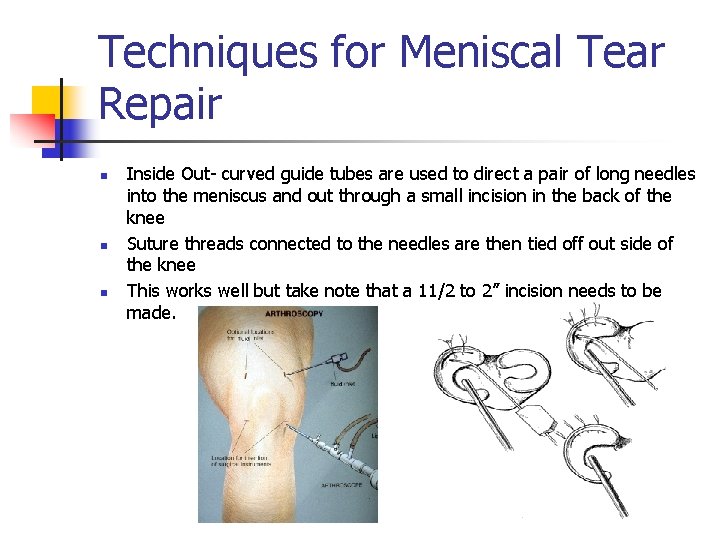 Techniques for Meniscal Tear Repair n n n Inside Out- curved guide tubes are