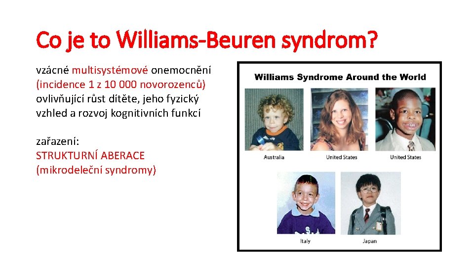 Co je to Williams-Beuren syndrom? vzácné multisystémové onemocnění (incidence 1 z 10 000 novorozenců)