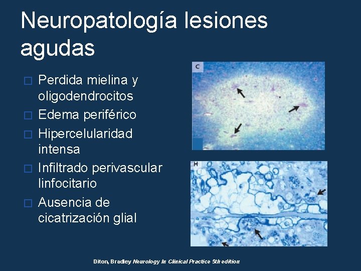 Neuropatología lesiones agudas � � � Perdida mielina y oligodendrocitos Edema periférico Hipercelularidad intensa