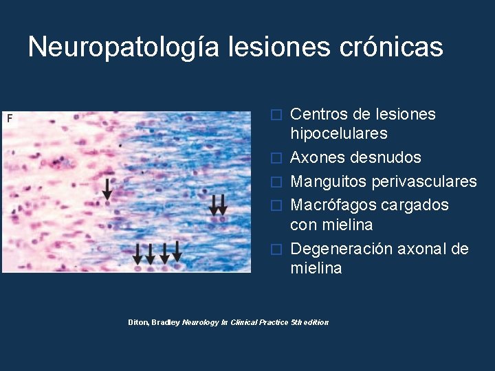 Neuropatología lesiones crónicas � � � Centros de lesiones hipocelulares Axones desnudos Manguitos perivasculares