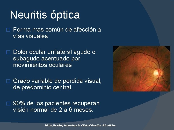 Neuritis óptica � Forma mas común de afección a vías visuales � Dolor ocular