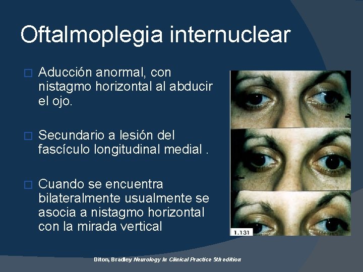 Oftalmoplegia internuclear � Aducción anormal, con nistagmo horizontal al abducir el ojo. � Secundario