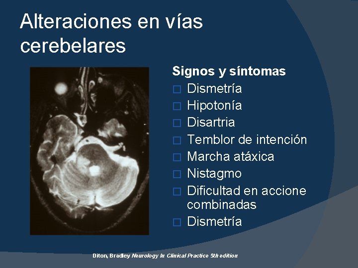 Alteraciones en vías cerebelares Signos y síntomas � Dismetría � Hipotonía � Disartria �