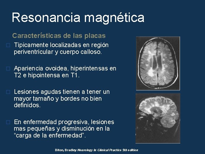 Resonancia magnética Características de las placas � Típicamente localizadas en región periventricular y cuerpo