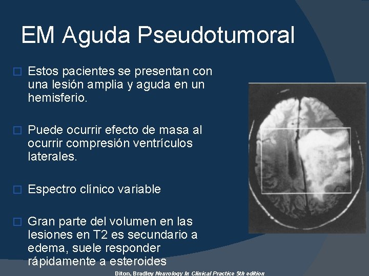 EM Aguda Pseudotumoral � Estos pacientes se presentan con una lesión amplia y aguda